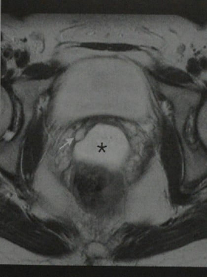 Снимки МРТ и КТ. Кисты шейки матки, влагалища и вульвы
