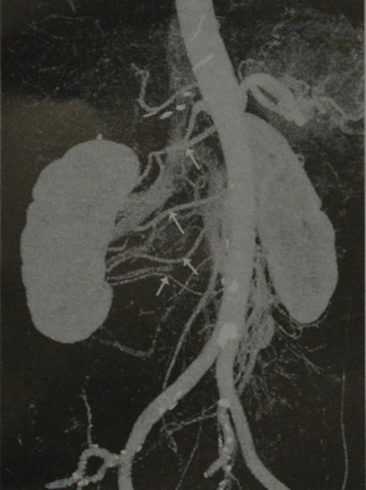Снимки МРТ и КТ. Добавочная почечная артерия