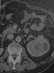 Снимки МРТ и КТ. Ксантогранулематозный пиелонефрит