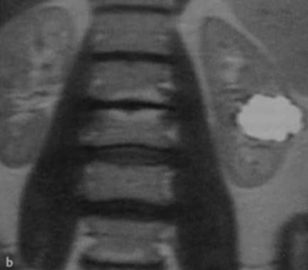 Снимки МРТ и КТ. Простые кисты почек