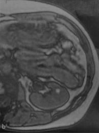 Снимки МРТ и КТ. Осложненные кисты почек II