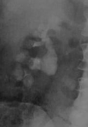 Снимки МРТ и КТ. Медуллярная губчатая почка
