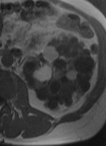 Снимки МРТ и КТ. Поликистозная болезнь почек (поликистоз)