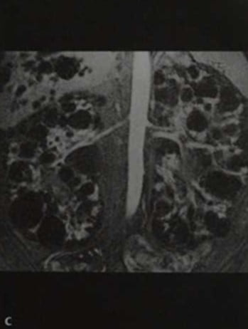Снимки МРТ и КТ. Поликистозная болезнь почек (поликистоз)