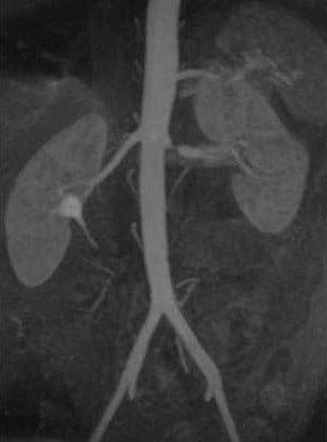 Снимки МРТ и КТ. Стеноз почечной артерии