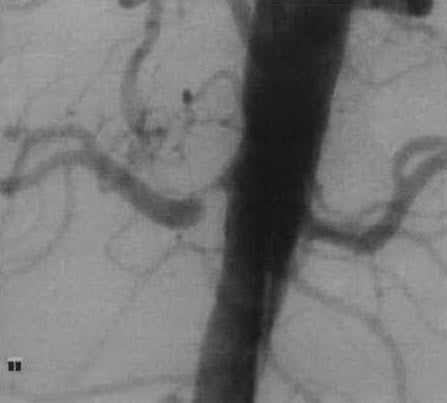 Снимки МРТ и КТ. Стеноз почечной артерии