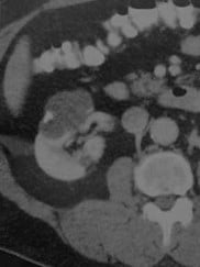 Снимки МРТ и КТ. Туберкулез почки