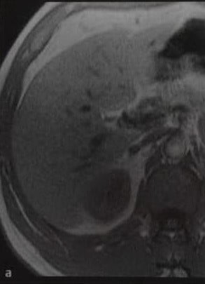 Снимки МРТ и КТ. Лимфома почки