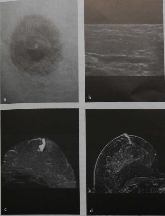 Снимки МРТ и КТ. Некровянистые выделения из соска 