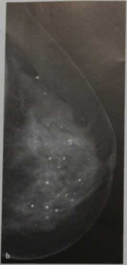 Снимки МРТ и КТ. Плеоморфные микрокальцинаты