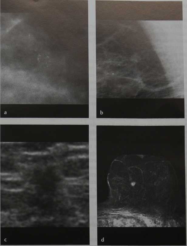 Снимки МРТ и КТ. Раннее обнаружение