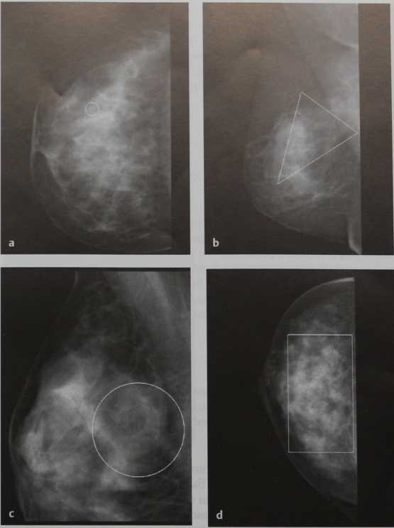 Снимки МРТ и КТ. Распределение микрокальцинатов