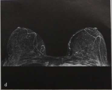 Снимки МРТ и КТ. Магнито-резонансная маммография