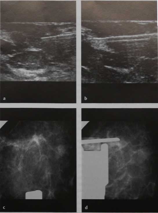 Снимки МРТ и КТ. Core-биопсия