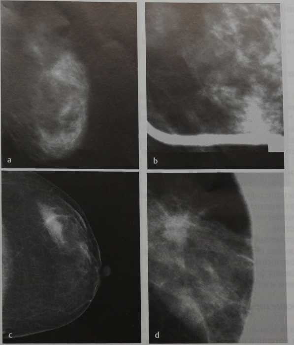 Снимки МРТ и КТ. Мамография, локальная компрессия