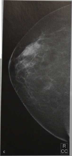 Снимки МРТ и КТ. Маммография, краниокаудальная проекция