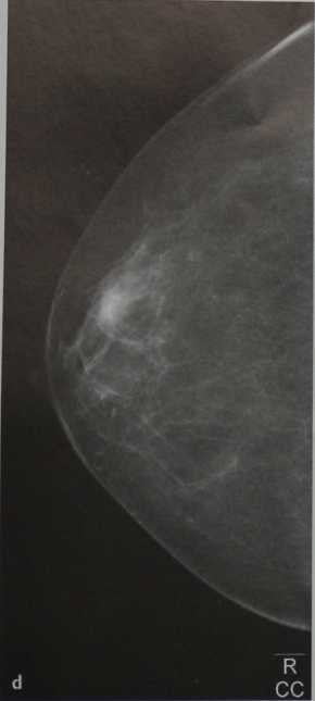 Снимки МРТ и КТ. Маммография, краниокаудальная проекция