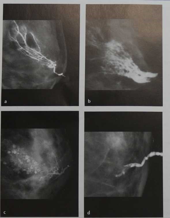 Снимки МРТ и КТ. Маммография, дуктография