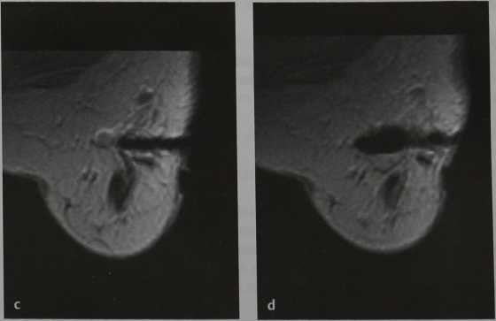Снимки МРТ и КТ. Вакуумная биопсия