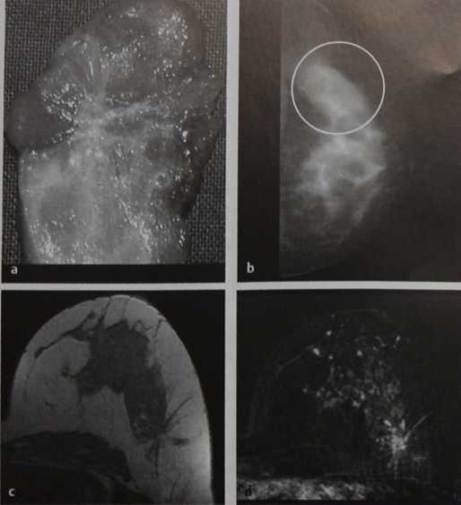 Снимки МРТ и КТ. Радиальный рубец