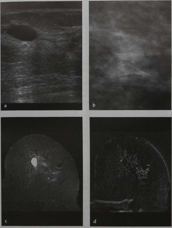 Снимки МРТ и КТ. Простая киста молочной железы