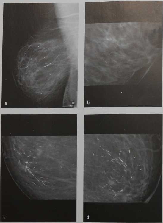 Снимки МРТ и КТ. Плазмоклеточный мастит