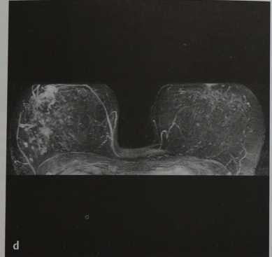 Снимки МРТ и КТ. Множественные периферические папилломы
