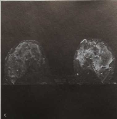 Снимки МРТ и КТ. Изменения молочной железы во время беременности
