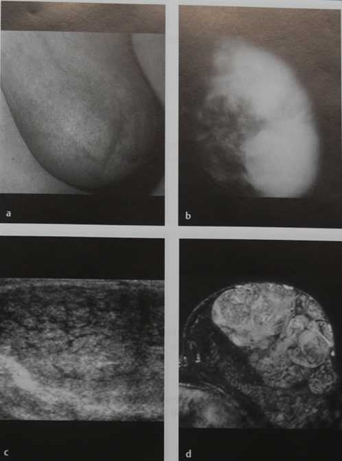 Снимки МРТ и КТ. Гигантская фиброаденома