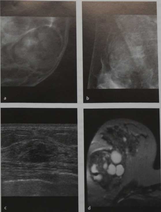 Снимки МРТ и КТ. Гамартома молочной железы