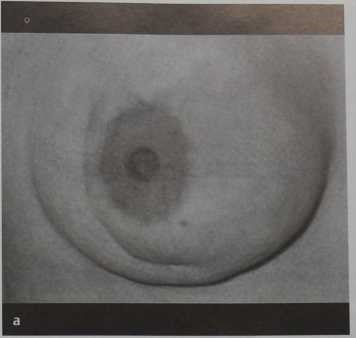 Снимки МРТ и КТ. Болезнь Мондора (тромбофлебит поверхностных вен)