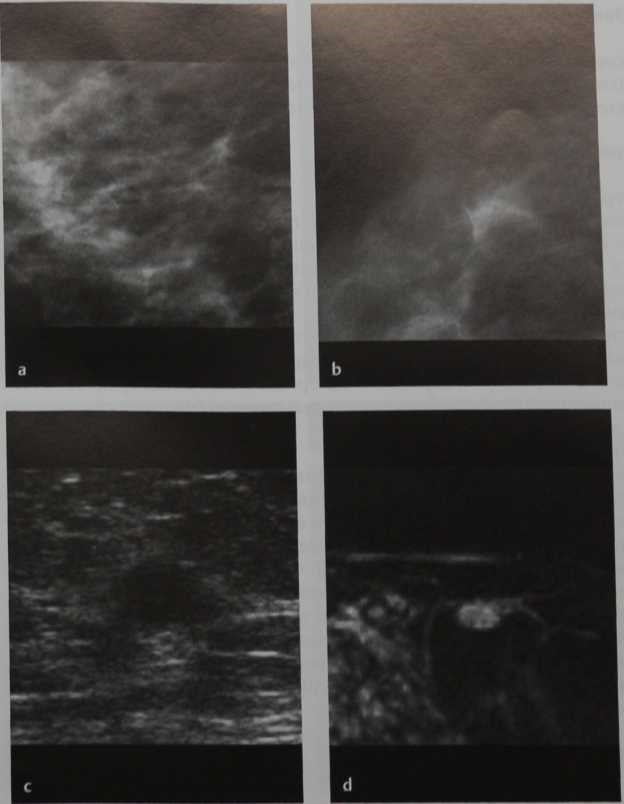 Снимки МРТ и КТ. Атипичная дольковая гиперплазия (ALH)