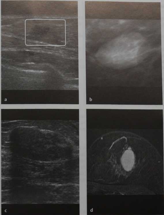 Снимки МРТ и КТ. Аденома молочной железы