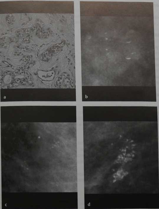 Снимки МРТ и КТ. Аденоз молочной железы