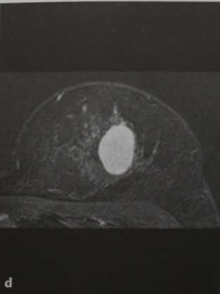Снимки МРТ и КТ. Тубулярная аденома молочной железы