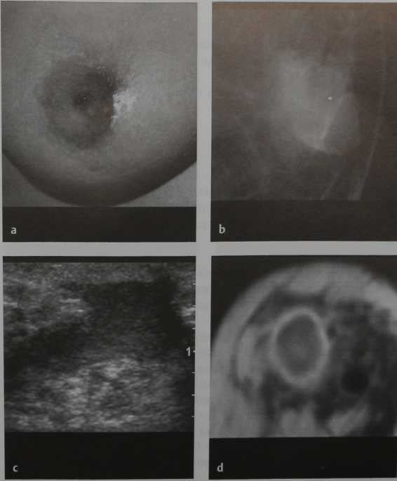 Снимки МРТ и КТ. Абсцесс молочной железы