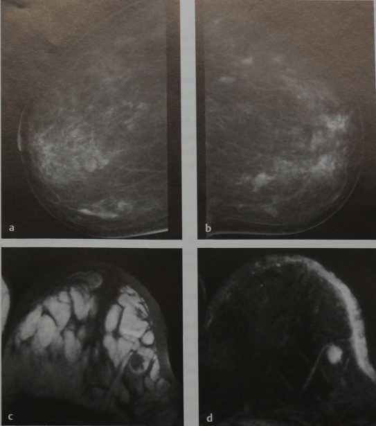 Снимки МРТ и КТ. Лимфома молочной железы