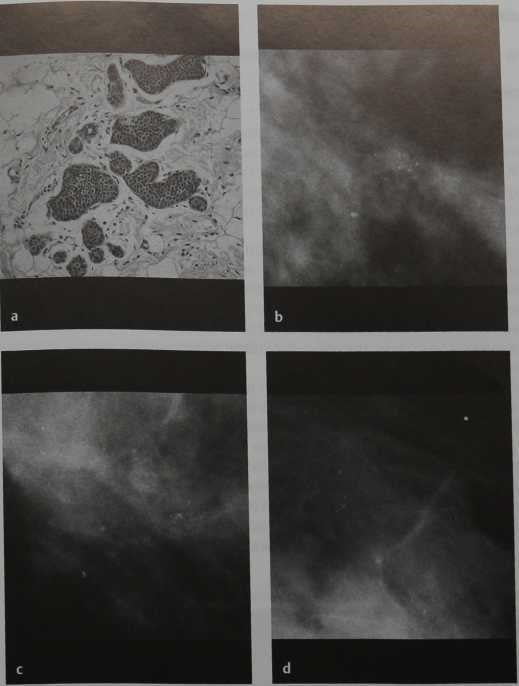 Снимки МРТ и КТ. Дольковый рак in situ (LCIS)