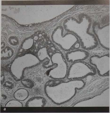 Снимки МРТ и КТ. Атипичная протоковая гиперплазия (ADH)