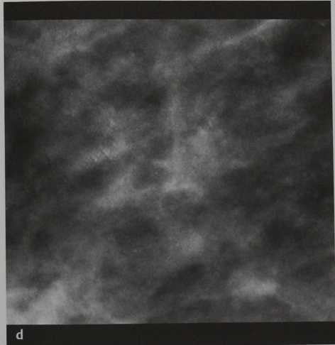 Снимки МРТ и КТ. Атипичная протоковая гиперплазия (ADH)