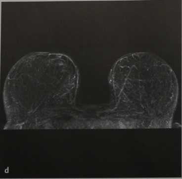 Снимки МРТ и КТ. Редукционная маммопластика