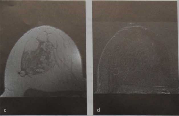 Снимки МРТ и КТ. Киста с жировым компонентом (олеогранулема)