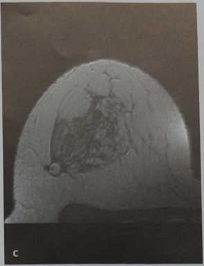 Снимки МРТ и КТ. Киста с жировым компонентом (олеогранулема)