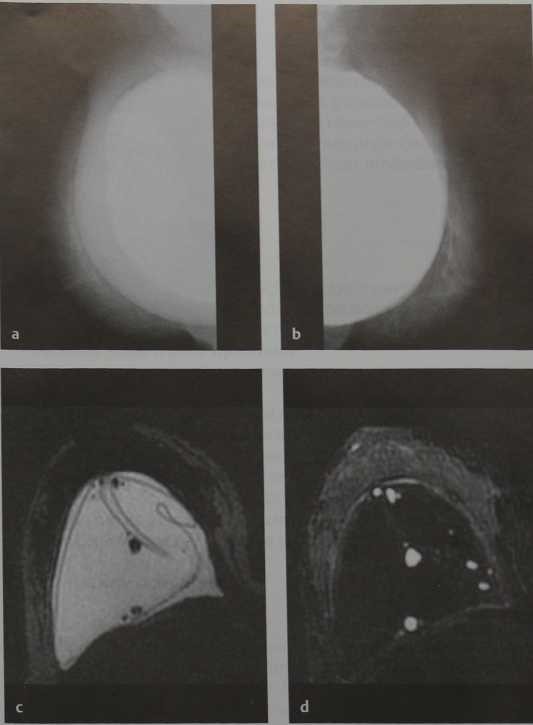 Снимки МРТ и КТ. Внутрикапсулярный разрыв