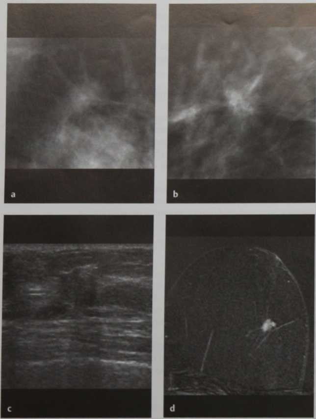 Снимки МРТ и КТ. Тубулярный рак