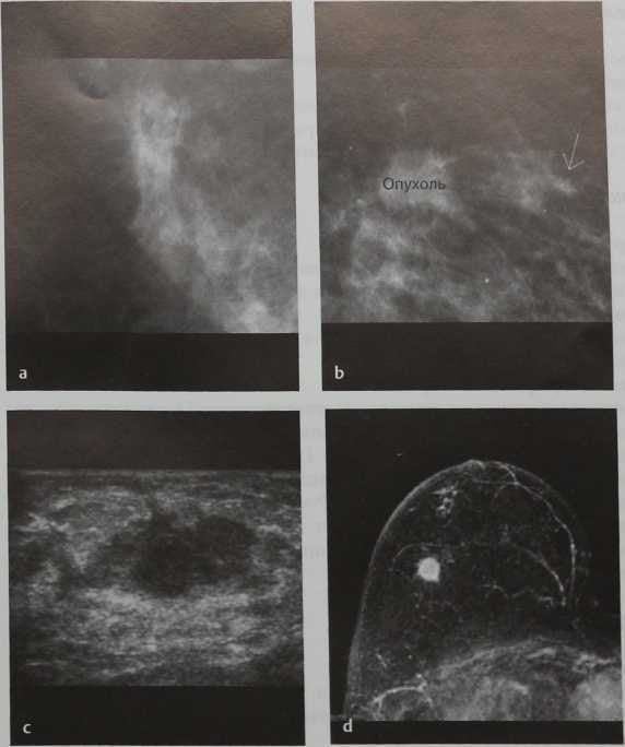 Снимки МРТ и КТ. Распространенный внутрипротоковый компонент