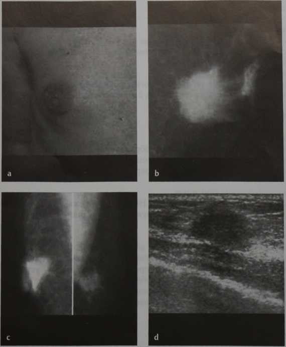 Снимки МРТ и КТ. Рак грудной железы у мужчин