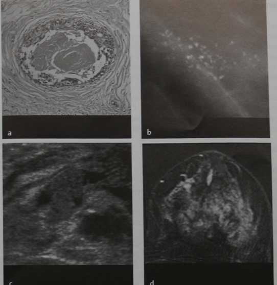 Снимки МРТ и КТ. Протоковый рак in situ высокой градации