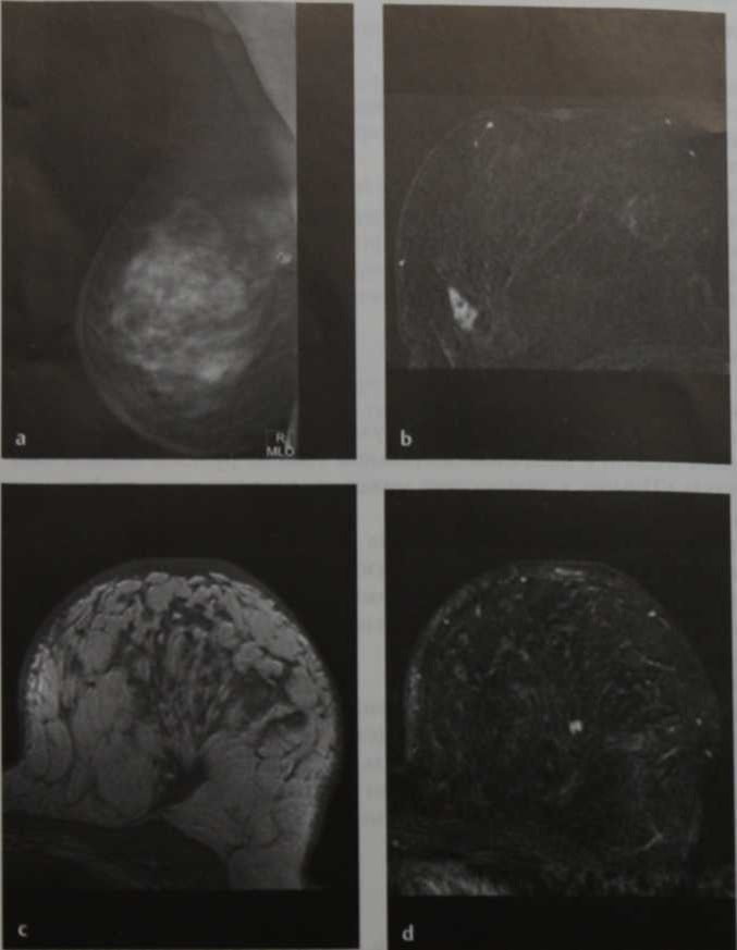 Снимки МРТ и КТ. Местный рецидив