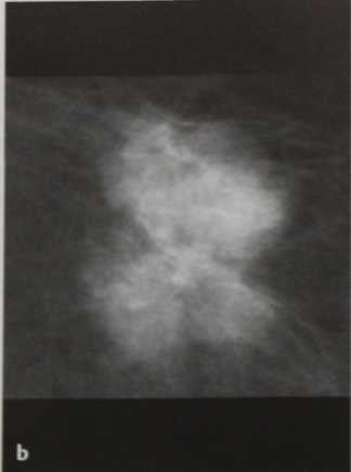 Снимки МРТ и КТ. Медуллярный рак